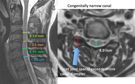 cervical spine mri results interpretation